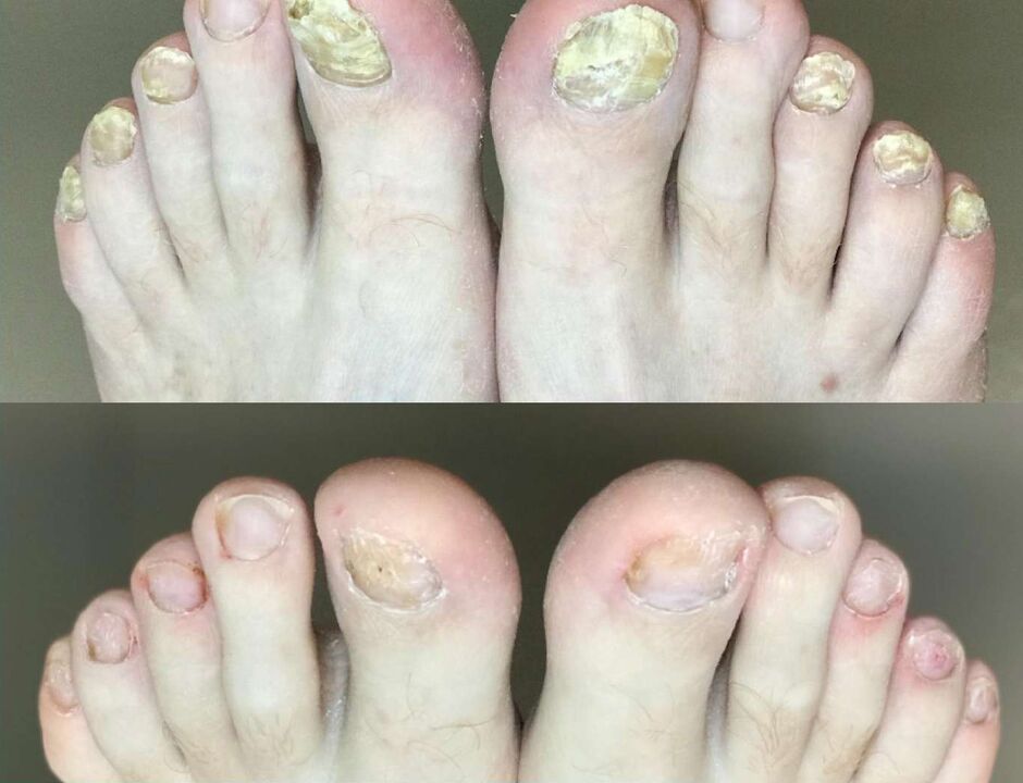 Virun an no der Behandlung, de filgus Promisil Creme