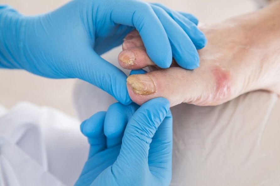 Nagelplacke betraff vu Pilz