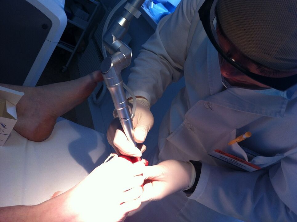 Laser Behandlung vu Missose